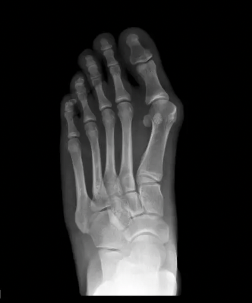 Best Shoes for Nurses With Bunions (2026 Guide for Comfort & Pressure Relief)